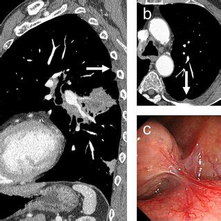 A case of failed pleural staging in a 78‐year‐old man (case 10 in Table ...