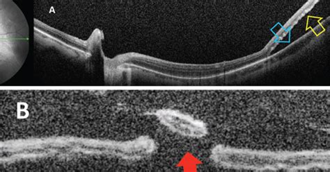 Rhegmatogenous Retinal Detachment: How to Detect, How to Manage