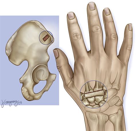 Disabling Hand Injuries in Boxing: Boxer's Knuckle and Traumatic Carpal ...