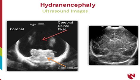 Hydranencephaly: A Neurologic Pathology Case Study | E-Gallery | University of Nebraska Medical ...