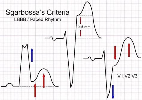 Sgarbossa Criteria • LITFL • ECG Library Diagnosis