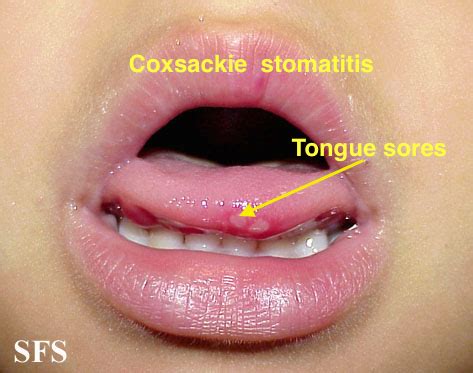 Hand-foot-and-mouth disease differential diagnosis - wikidoc