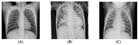 Normal Chest X Ray Vs Pneumonia