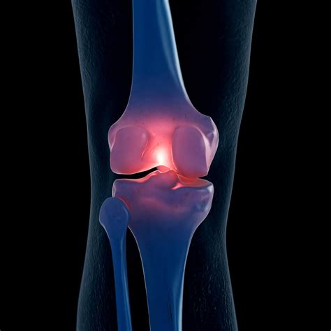 Osteoarthritis Treatment | Northeast Knee & Joint Institute