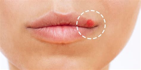 How To Get Rid Of Lip Pimple: Useful Tips