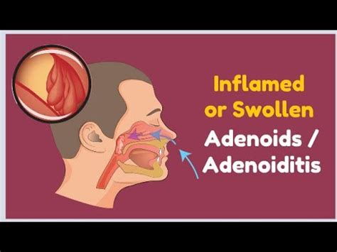 Inflamed or Swollen Adenoids / Adenoiditis - YouTube