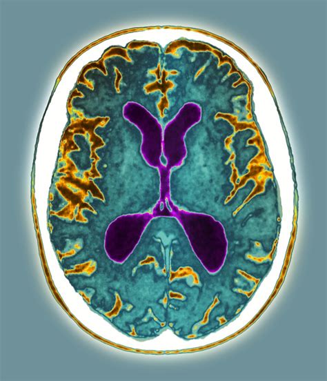 Alzheimer's demands multiple diagnostics- Clinical Advisor