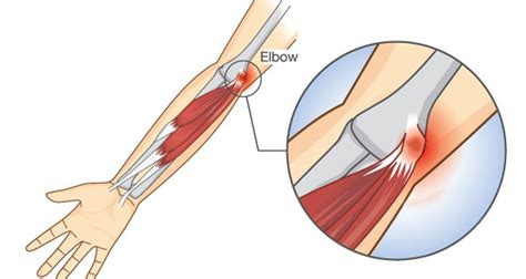 Golfer's Elbow - Symptoms, Causes, Treatment & Rehabilitation