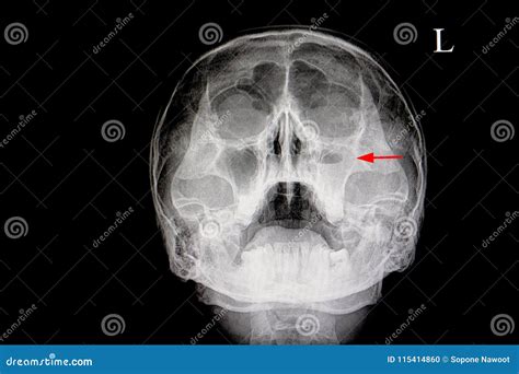 Sinusite maxillary aguda foto de stock. Imagem de nathans - 115414860