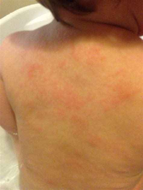 Food allergy? Eczema? - Netmums Chat