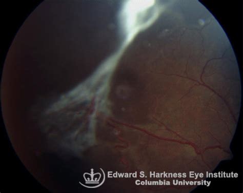 Sickle Cell Proliferative Retinopathy | Vagelos College of Physicians and Surgeons