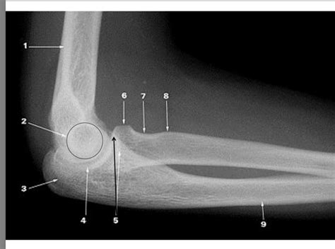 humerus/elbow/ulnar/radius xray labeling Diagram | Quizlet