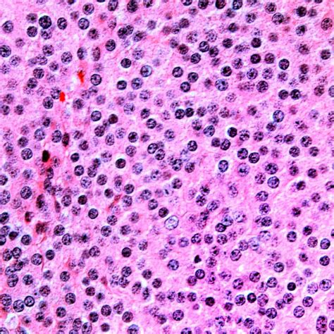 Well-Differentiated Neuroendocrine Tumor, Pancreas | Basicmedical Key