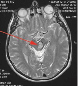 What is a cavernoma - Cavernoma Alliance UK (CAUK)