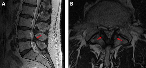 Cureus | Ossification of the Ligamentum Flavum of the Lumbar Spine