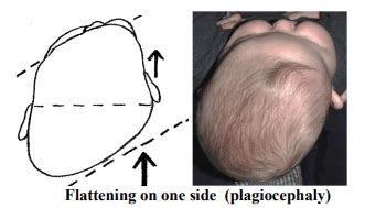 Plagiocephaly