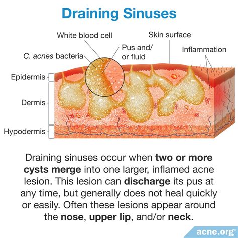 What Is a Draining Sinus? - Acne.org