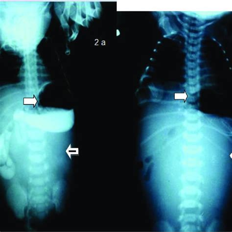 CAT scan image showing the hugely distended bladder reaching middle ...