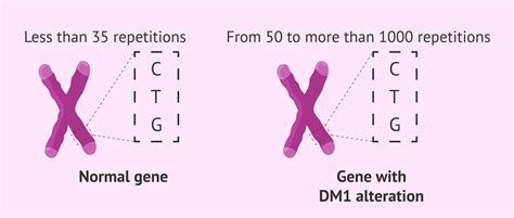 Steinert's myotonic dystrophy - Symptoms, diagnosis and treatment