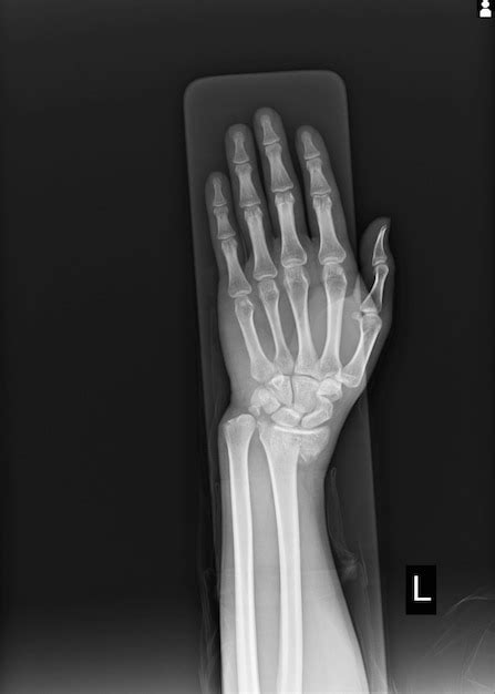 Premium Photo | X-ray left wrist joint fracture with displacement distal end left radius.