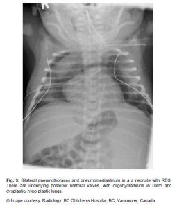 AIR TRAPPING, PNEUMOTHORAX, PNEUMOMEDIASTINUM, PNEUMOPERICARDIUM DAN PNEUMOPERITONEUM pada ...