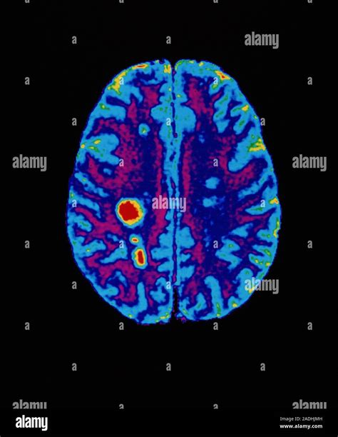 Multiple sclerosis. Coloured magnetic resonance image (MRI) scan of an ...