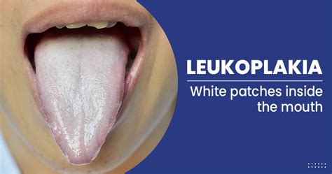 Leukoplakia- causes, symptoms, treatments, preventions and more