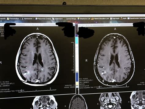 MRI Results