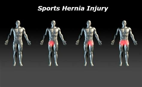 Sports Hernia Injury: A Complete Full-Scale Review (Athletic Pubalgia)