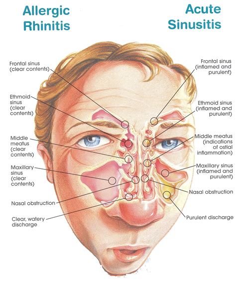 Sinusitis Acute Maxillary Signs