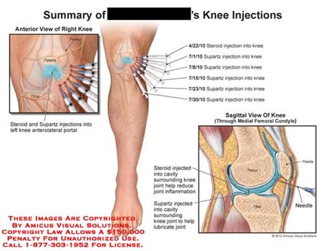 Summary of Knee Injections