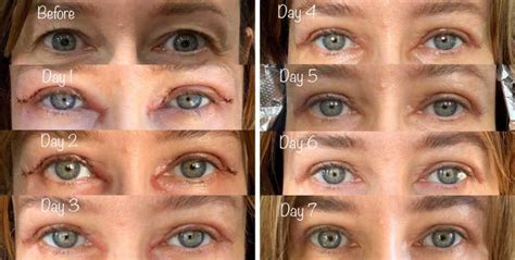 Upper Blepharoplasty Before and After Gallery | Taban MD