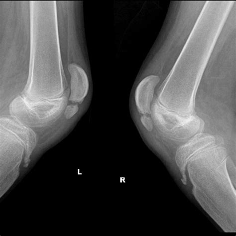 Pre-op standing photograph showing severe crouch gait. | Download ...