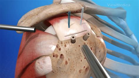 Rotator Cuff Repair - What does a Rotator Cuff Repair surgery look like?