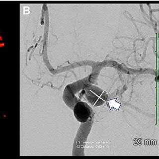 Catheter Angiogram of the Brain A. Three-dimensional rotational ...