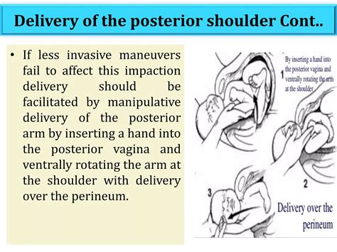 SHOULDER DYSTOCIA | PPT