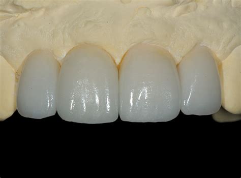 All Ceramic Crown Anterior