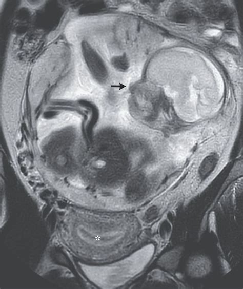 Abdominal Ectopic Pregnancy - MEDizzy