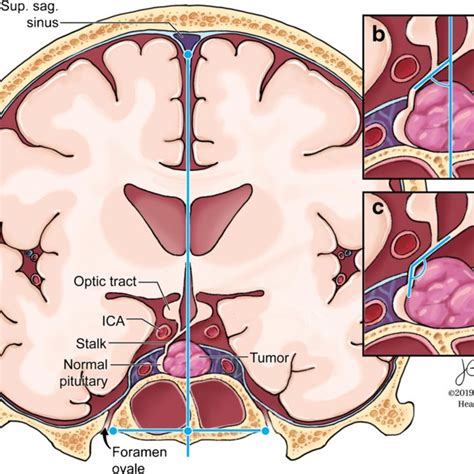 Sella Turcica Anatomy