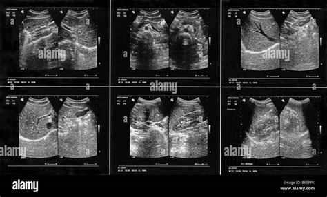 Abdominal Mass Ultrasound