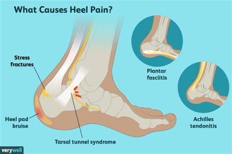 What Causes Heel Pain? — Foot & Ankle of West Georgia