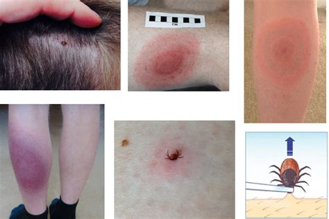 Lyme disease: signs and symptoms - GOV.UK