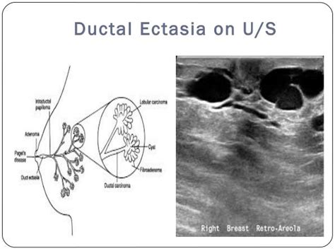 Ultrasound breast mass