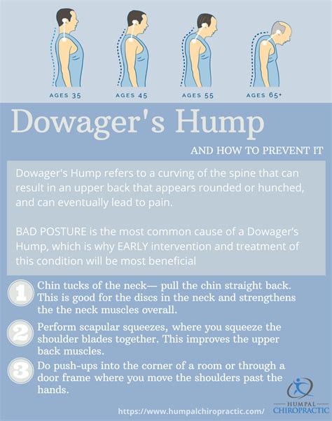 Humpal Chiropractic - Dowager's Hump: What is it? Can I prevent it?