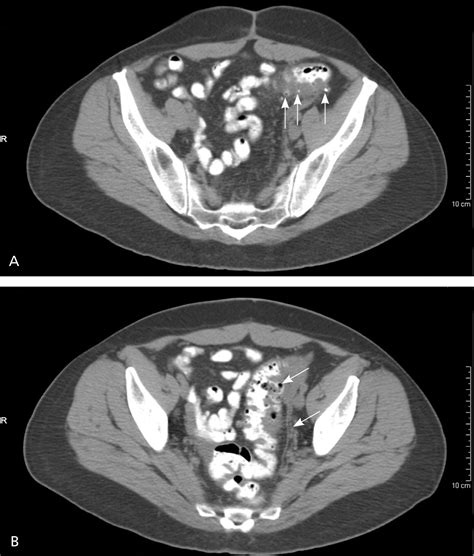 Diagnosis and Management of Acute Diverticulitis | AAFP