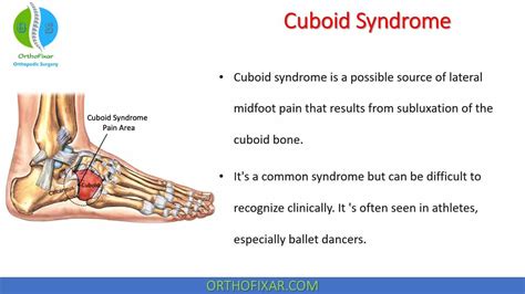 Cuboid Syndrome - Easy Explained | OrthoFixar 2024