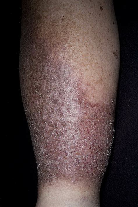 Stasis Dermatitis on Legs Pictures – 174 Photos & Images / illnessee.com