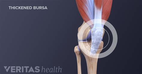 Causes of Knee Bursitis (Prepatellar Bursitis)