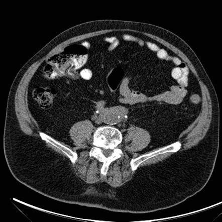 Retroperitoneal fibrosis | Radiology Reference Article | Radiopaedia.org