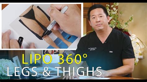 Virtual Consultation | Lipo 360 Thighs | Leg Liposuction | Lipedema ...